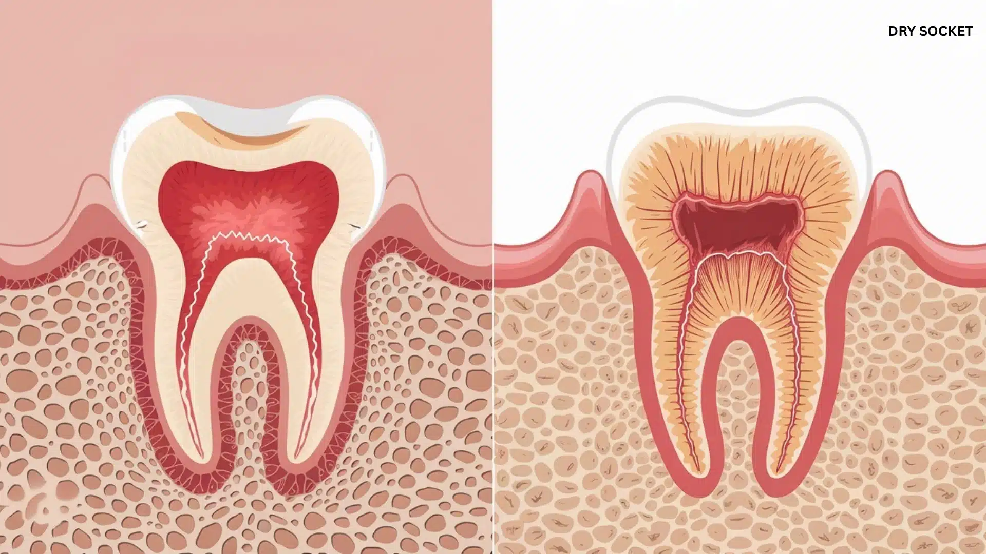 Diagram comparing a healthy tooth socket with one affected by dry socket