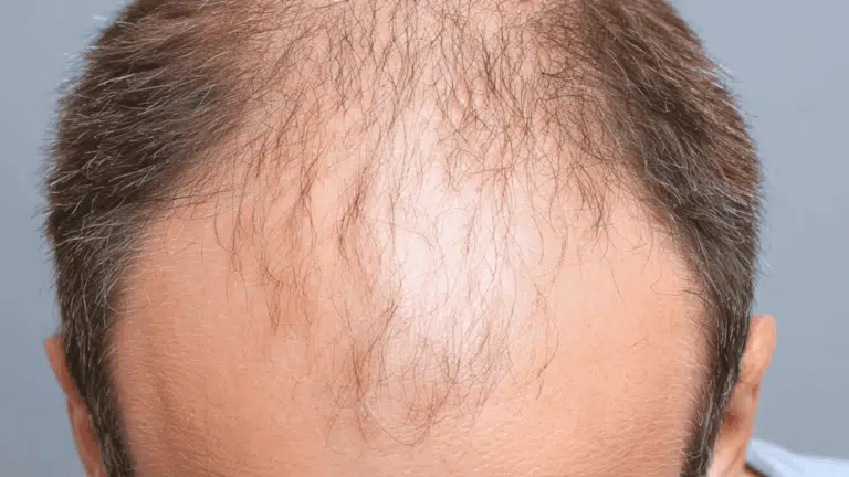 exosomes for hair loss treatment