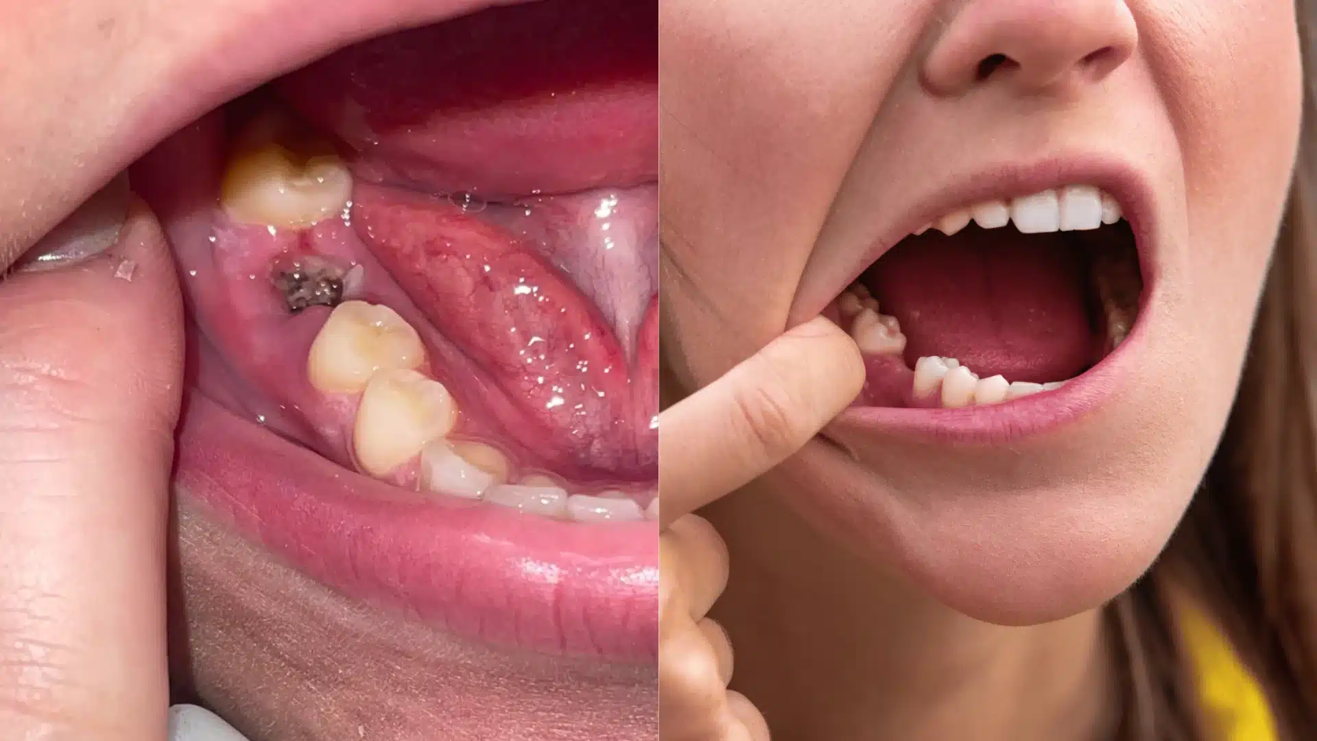 Split image showing a close-up view of a mouth with a noticeable tooth cavity on the left and a person pointing to their back molar area on the right