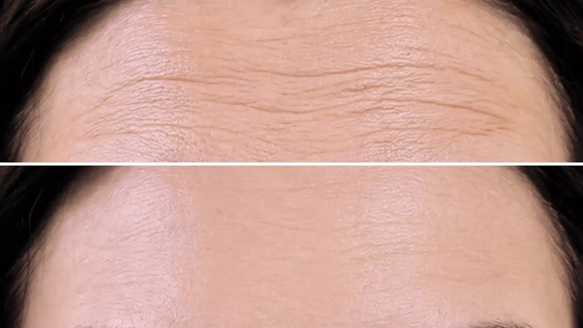 Before and after forehead close up showing visible lines reduced after skincare treatment