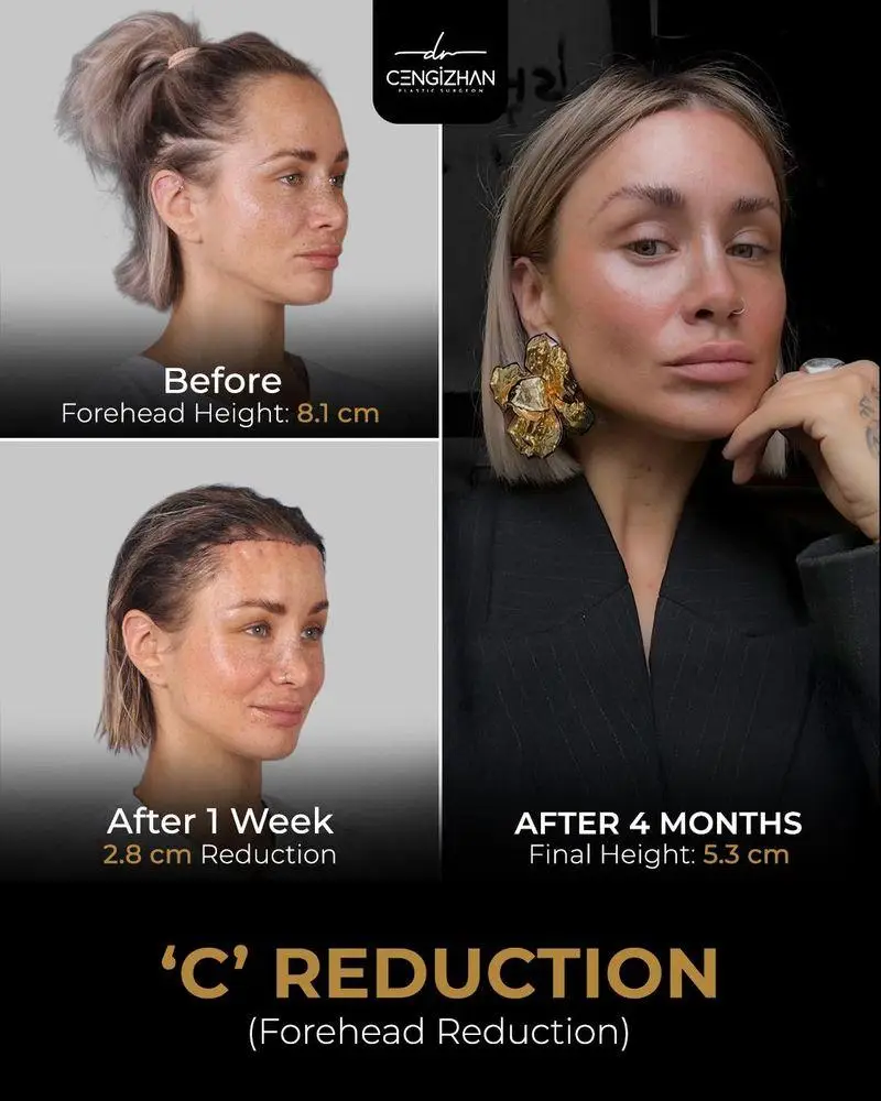Best Forehead Reduction Surgery in Turkey: Why Patients Choose Dr. Cengizhan