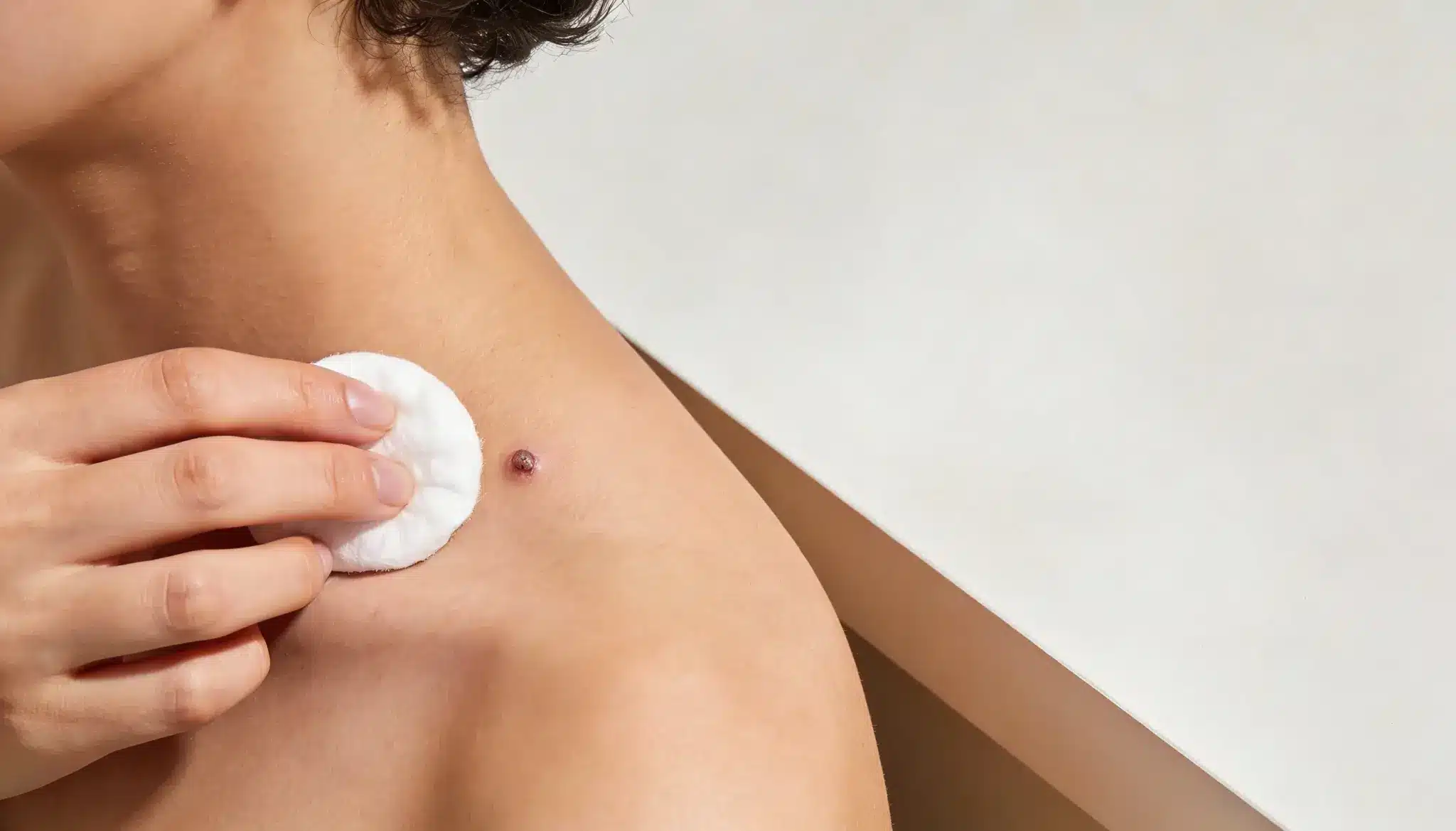 Close-up of a hand applying a cotton pad near a small raised mole on a person's shoulder or neck area