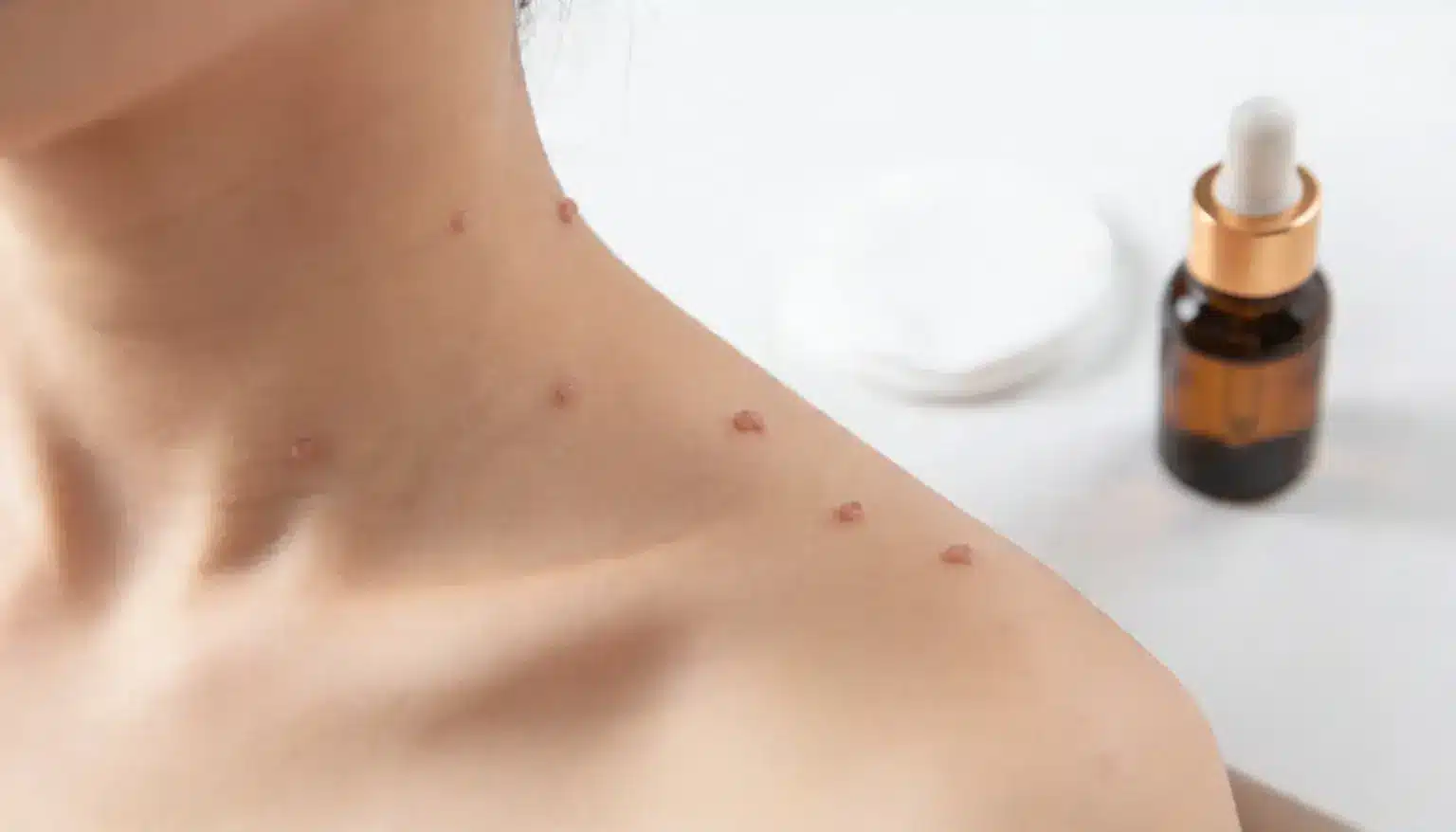 Close-up of skin on the neck and shoulder area showing multiple raised skin tags next to a brown dropper bottle and white cotton pads