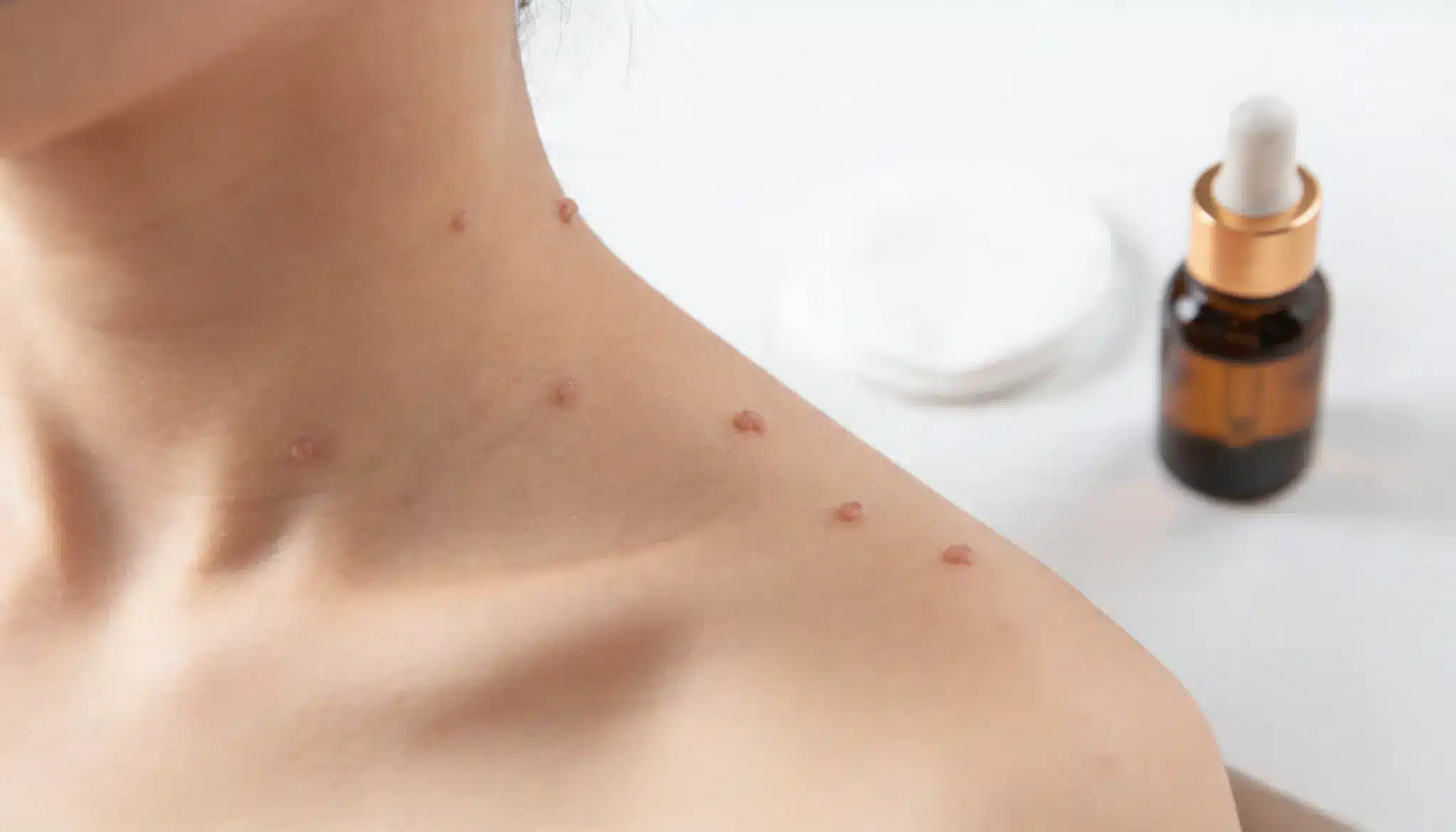 Close-up of skin on the neck and shoulder area showing multiple raised skin tags next to a brown dropper bottle and white cotton pads