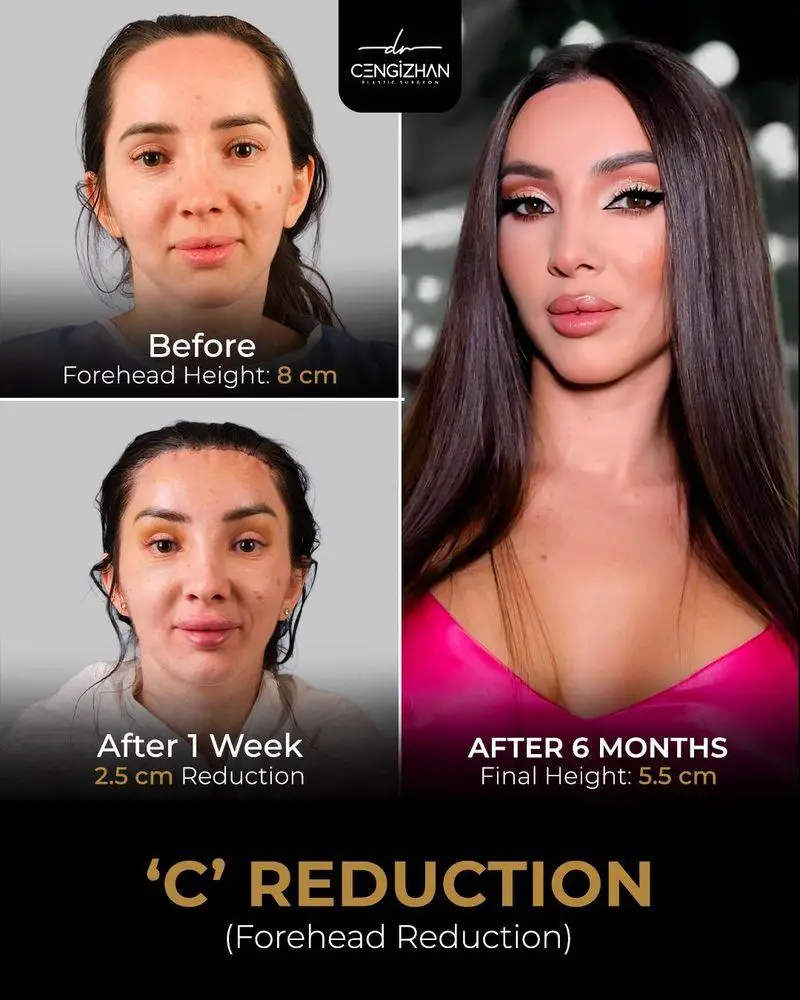 Three images showing a woman before and after forehead reduction surgery over six months