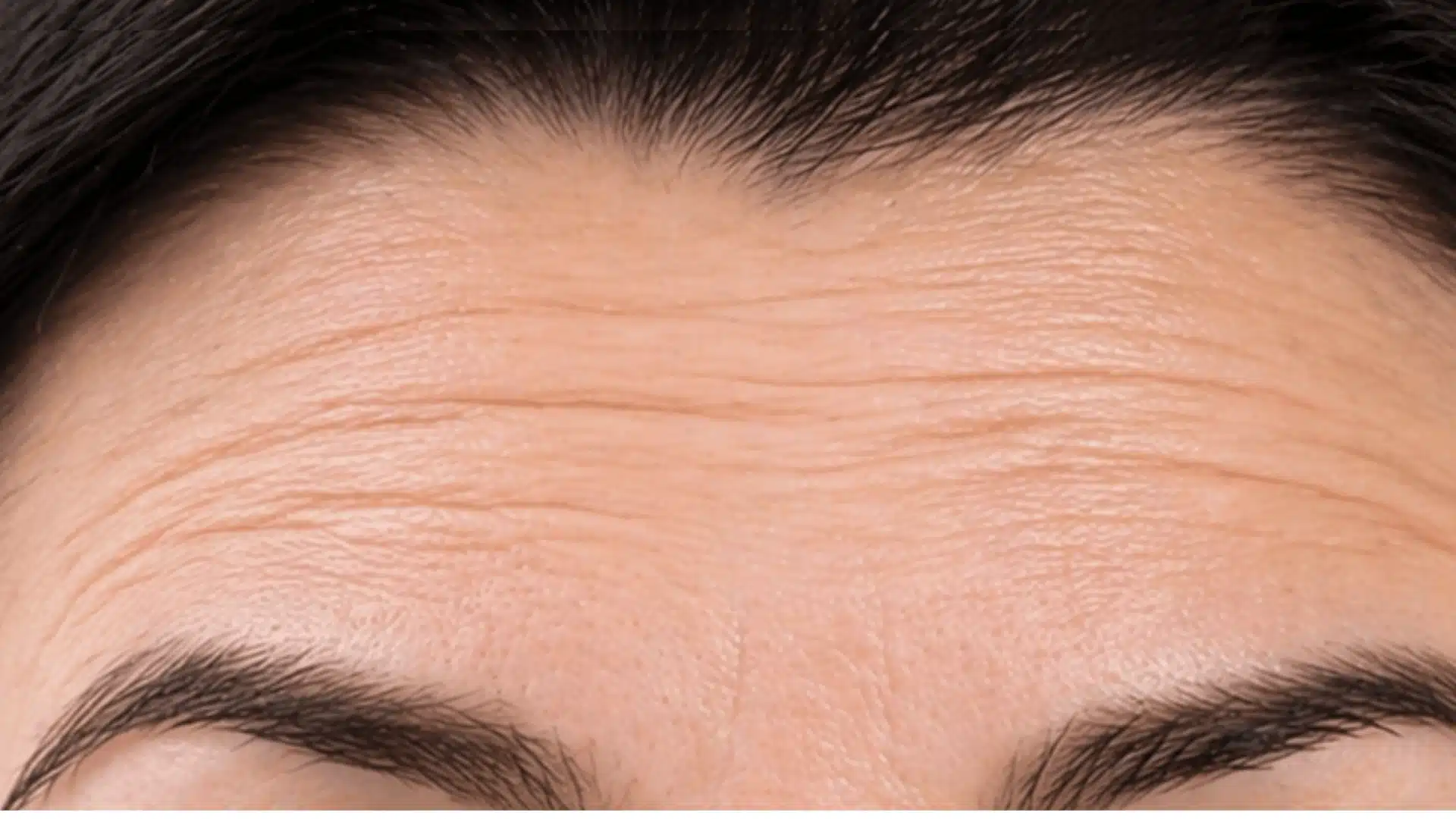 Minimal skincare layout with before and after forehead comparison and neutral background design