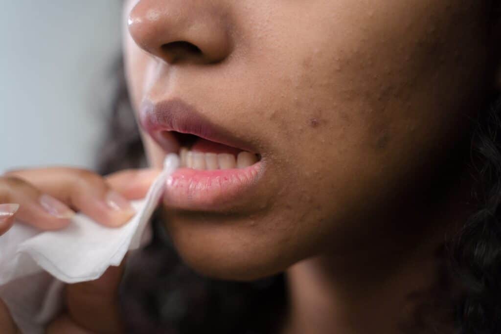 Hyperpigmentation After Acne: How to Support Clearer Skin