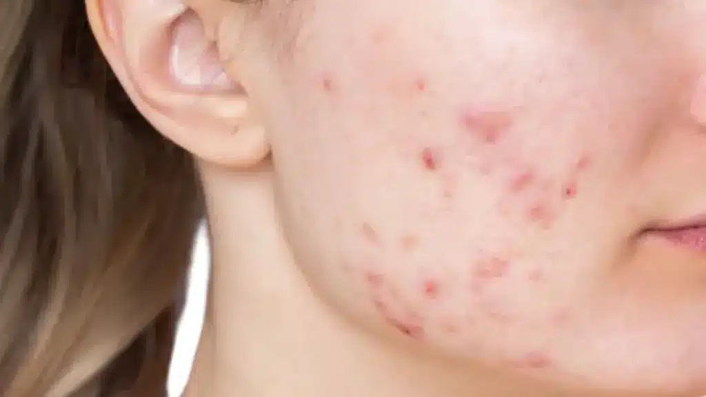 Close-up of fair skin on a cheek and jawline showing moderate inflammatory acne blemishes and redness near the ear.