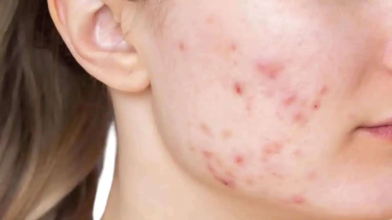 Close-up of fair skin on a cheek and jawline showing moderate inflammatory acne blemishes and redness near the ear.
