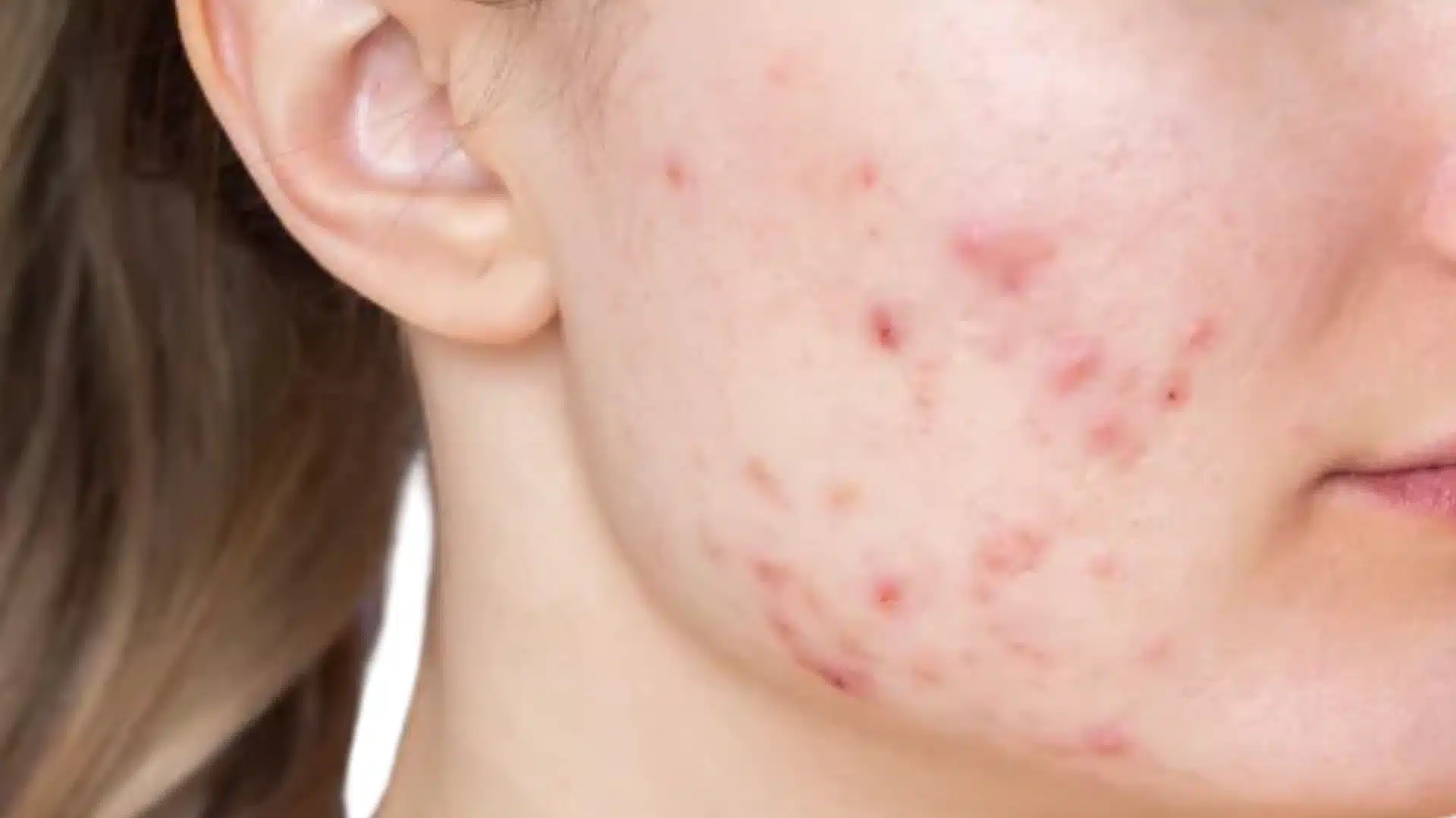 Close-up of fair skin on a cheek and jawline showing moderate inflammatory acne blemishes and redness near the ear.