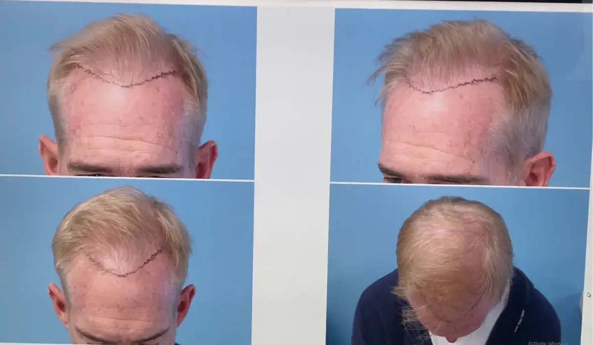 Man's scalp surgery marks shown in four separate images on a blue background