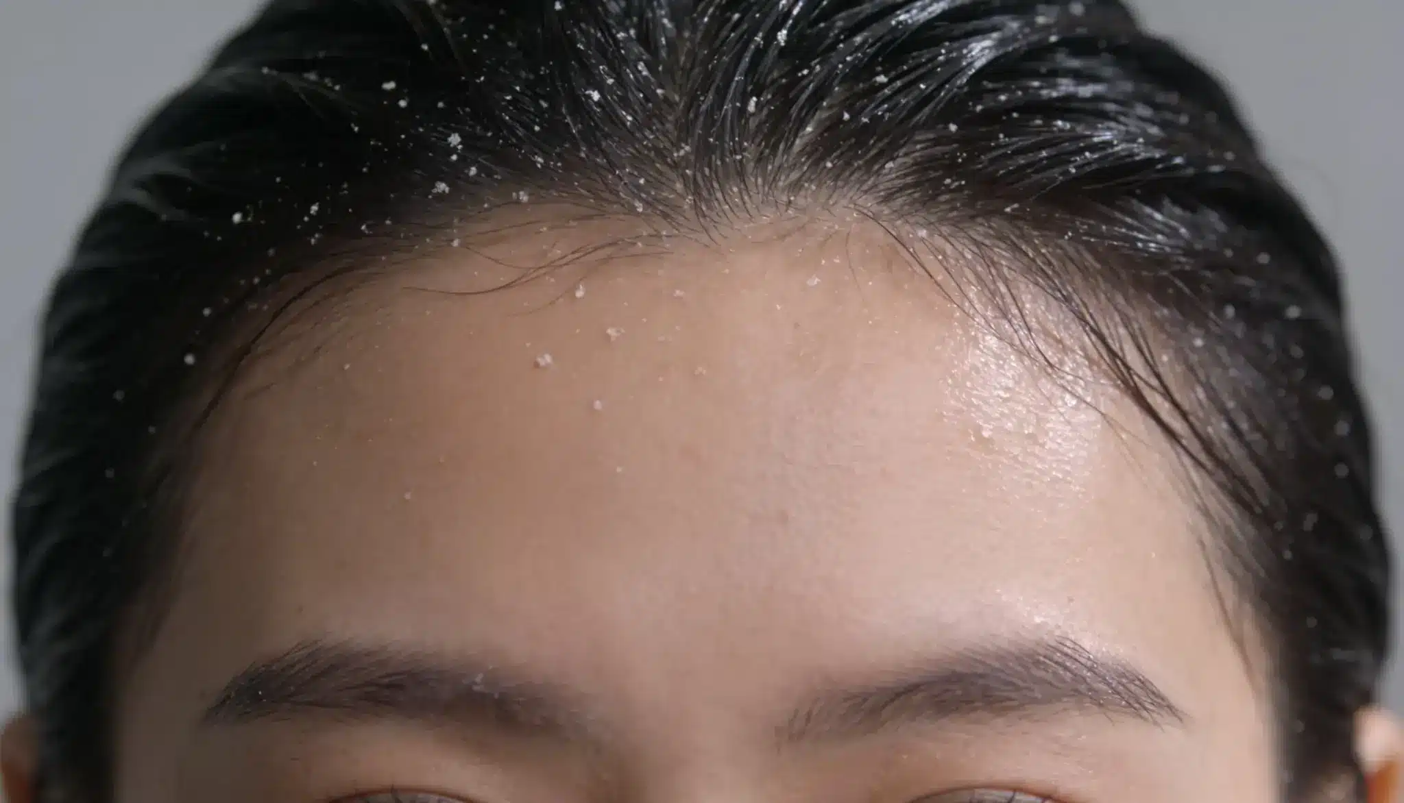 Close up of mild dandruff flakes visible along a womans hairline and scalp