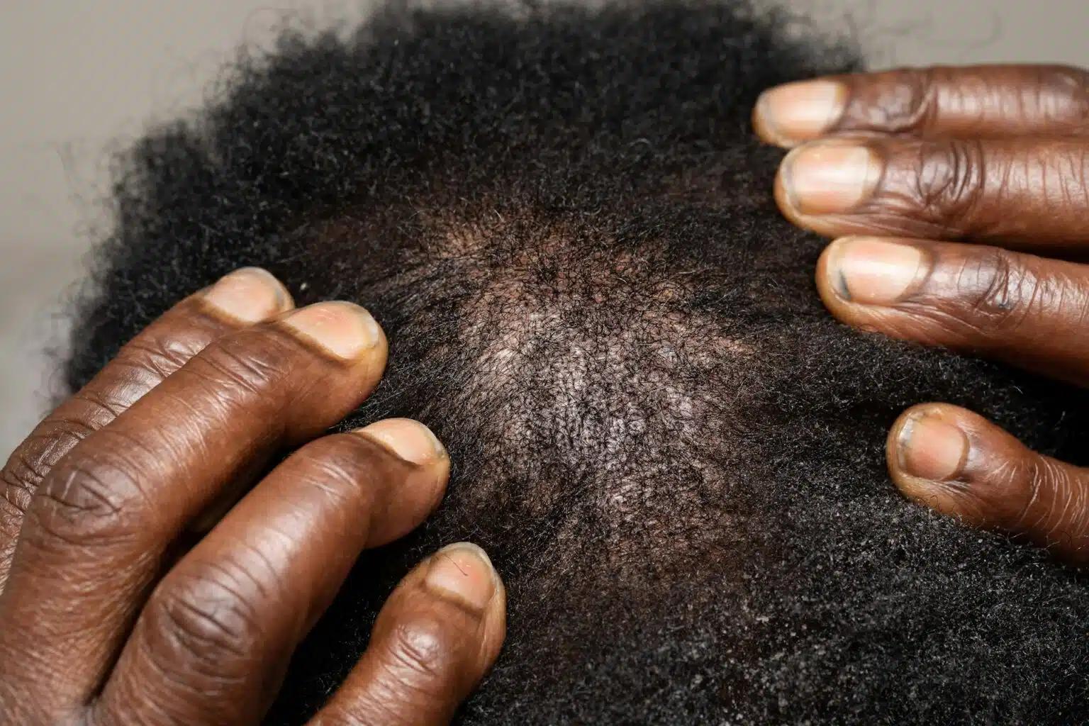 Top view fingers on afro american head scalp top close-up show hair-loss