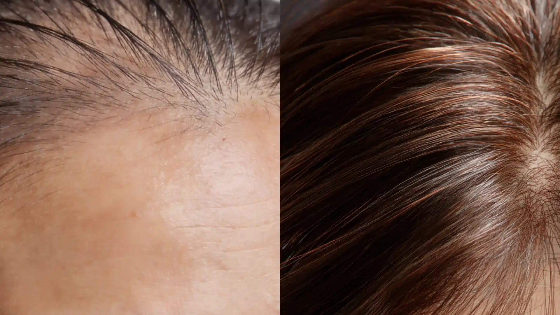 Before and after images of a hair transplant, showcasing significant hair growth and improved hairline